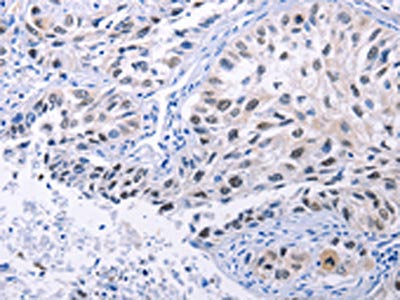 The image on the left is immunohistochemistry of paraffin-embedded Human lung cancer tissue using HMGB3 Antibody(HMGB3 Antibody) at dilution 1/20, on the right is treated with synthetic peptide. (Original magnification: ×200)Rabbit anti-Human HMGB3 Polyclonal Antibody