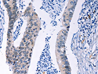 The image on the left is immunohistochemistry of paraffin-embedded Human colon cancer tissue using the antibody Antibody) at dilution 1/20, on the right is treated with synthetic peptide. (Original magnification: ×200)Rabbit anti-Human HMGB3 Polyclonal Antibody