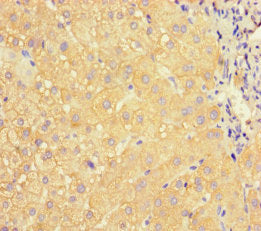 Immunohistochemistry of paraffin-embedded human liver cancer using APOC3 Antibody at dilution of 1:100Rabbit anti-Human APOC3 Polyclonal Antibody