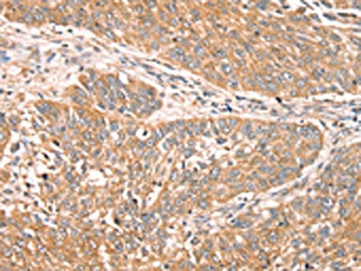 The image on the left is immunohistochemistry of paraffin-embedded Human lung cancer tissue using RPS6KA1 Antibody(RPS6KA1 Antibody) at dilution 1/30, on the right is treated with fusion protein. (Original magnification: ×200)Rabbit anti-Human RPS6KA1 Polyclonal Antibody
