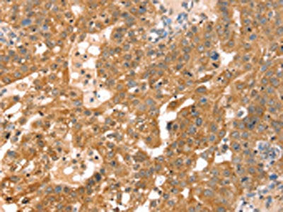The image on the left is immunohistochemistry of paraffin-embedded Human breast cancer tissue using the antibody Antibody) at dilution 1/30, on the right is treated with fusion protein. (Original magnification: ×200)Rabbit anti-Human RPS6KA1 Polyclonal Antibody