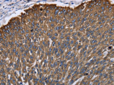 The image on the left is immunohistochemistry of paraffin-embedded Human lung cancer tissue using KRT31 Antibody(KRT31 Antibody) at dilution 1/30, on the right is treated with fusion protein. (Original magnification: ×200)