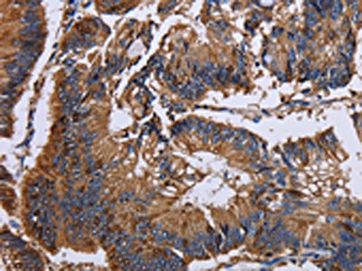The image on the left is immunohistochemistry of paraffin-embedded Human colon cancer tissue using the antibody Antibody) at dilution 1/30, on the right is treated with fusion protein. (Original magnification: ×200)