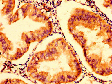 IHC image of HEXA Antibody diluted at 1:300 and staining in paraffin-embedded human endometrial cancer performed on a Leica BondTM system. After dewaxing and hydration, antigen retrieval was mediated by high pressure in a citrate buffer (pH 6.0). Section was blocked with 10% normal goat serum 30min at RT. Then primary antibody (1% BSA) was incubated at 4°C overnight. The primary is detected by a biotinylated secondary antibody and visualized using an HRP conjugated SP system.Rabbit anti-Human HEXA Polyclonal Antibody