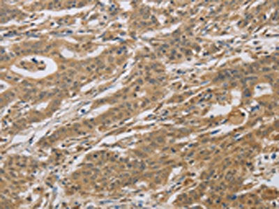 The image on the left is immunohistochemistry of paraffin-embedded Human gastric cancer tissue using CYFIP2 Antibody(CYFIP2 Antibody) at dilution 1/25, on the right is treated with fusion protein. (Original magnification: ×200)Rabbit anti-Human CYFIP2 Polyclonal Antibody
