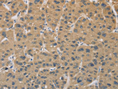The image on the left is immunohistochemistry of paraffin-embedded Human liver cancer tissue using the antibody Antibody) at dilution 1/25, on the right is treated with fusion protein. (Original magnification: ×200)Rabbit anti-Human CYFIP2 Polyclonal Antibody