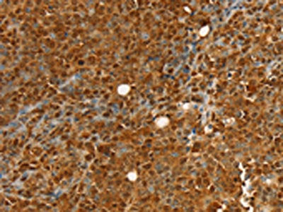 The image on the left is immunohistochemistry of paraffin-embedded Human ovarian cancer tissue using RAN Antibody(RAN Antibody) at dilution 1/20, on the right is treated with fusion protein. (Original magnification: ×200)Rabbit anti-Human RAN Polyclonal Antibody