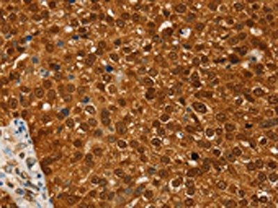 The image on the left is immunohistochemistry of paraffin-embedded Human breast cancer tissue using the antibody Antibody) at dilution 1/20, on the right is treated with fusion protein. (Original magnification: ×200)Rabbit anti-Human RAN Polyclonal Antibody
