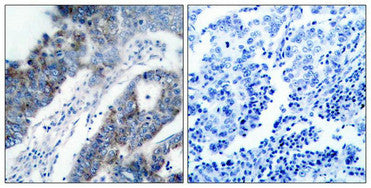 Immunohistochemical analysis of paraffin-embedded human breast carcinoma tissue using ASK1(Ab-83) Antibody(left) or the same antibody preincubated with blocking peptide(right).Rabbit anti-Human MAP3K5 Polyclonal Antibody