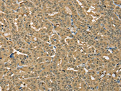 The image on the left is immunohistochemistry of paraffin-embedded Human thyroid cancer tissue using the antibody Antibody) at dilution 1/25, on the right is treated with fusion protein. (Original magnification: ×200)Rabbit anti-Human PSMC1 Polyclonal Antibody