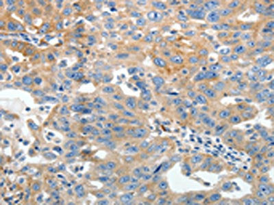 The image on the left is immunohistochemistry of paraffin-embedded Human ovarian cancer tissue using AKAP12 Antibody(AKAP12 Antibody) at dilution 1/40, on the right is treated with synthetic peptide. (Original magnification: ×200)Rabbit anti-Human AKAP12 Polyclonal Antibody