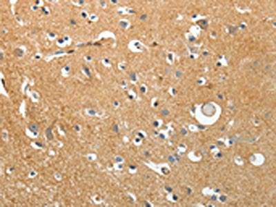 The image on the left is immunohistochemistry of paraffin-embedded Human brain tissue using the antibody Antibody) at dilution 1/40, on the right is treated with synthetic peptide. (Original magnification: ×200)Rabbit anti-Human AKAP12 Polyclonal Antibody