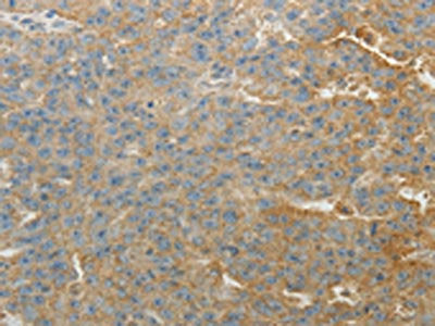 The image on the left is immunohistochemistry of paraffin-embedded Human ovarian cancer tissue using SULT1E1 Antibody(SULT1E1 Antibody) at dilution 1/30, on the right is treated with fusion protein. (Original magnification: ×200)Rabbit anti-Human SULT1E1 Polyclonal Antibody