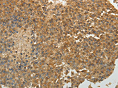 The image on the left is immunohistochemistry of paraffin-embedded Human liver cancer tissue using the antibody Antibody) at dilution 1/30, on the right is treated with fusion protein. (Original magnification: ×200)Rabbit anti-Human SULT1E1 Polyclonal Antibody