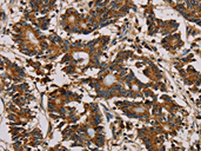 The image on the left is immunohistochemistry of paraffin-embedded Human colon cancer tissue using MRPL11 Antibody(MRPL11 Antibody) at dilution 1/20, on the right is treated with fusion protein. (Original magnification: ×200)
