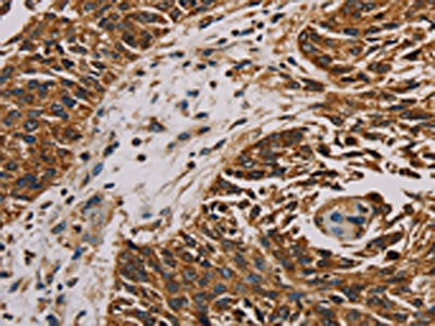 The image on the left is immunohistochemistry of paraffin-embedded Human lung cancer tissue using the antibody Antibody) at dilution 1/20, on the right is treated with fusion protein. (Original magnification: ×200)