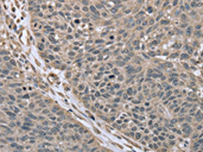 The image on the left is immunohistochemistry of paraffin-embedded Human lung cancer tissue using RHEB Antibody(RHEB Antibody) at dilution 1/40, on the right is treated with synthetic peptide. (Original magnification: ×200)Rabbit anti-Human RHEB Polyclonal Antibody