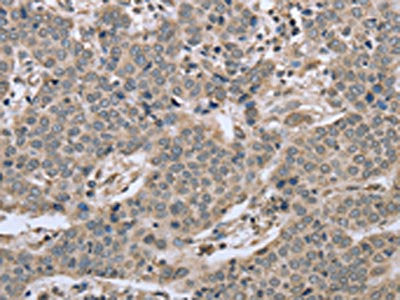 The image on the left is immunohistochemistry of paraffin-embedded Human liver cancer tissue using the antibody Antibody) at dilution 1/40, on the right is treated with synthetic peptide. (Original magnification: ×200)Rabbit anti-Human RHEB Polyclonal Antibody