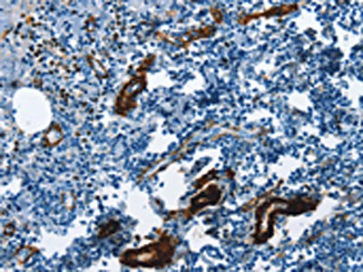 The image on the left is immunohistochemistry of paraffin-embedded Human tonsil tissue using ACTA2 Antibody(ACTA2 Antibody) at dilution 1/30, on the right is treated with synthetic peptide. (Original magnification: ×200)