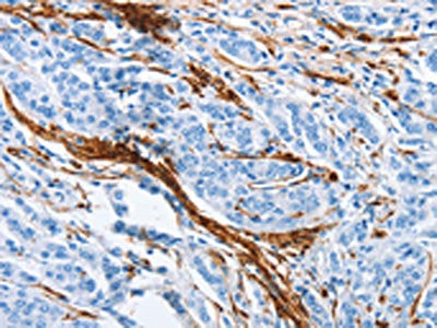 The image on the left is immunohistochemistry of paraffin-embedded Human prostate cancer tissue using the antibody Antibody) at dilution 1/30, on the right is treated with synthetic peptide. (Original magnification: ×200)