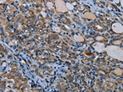 The image on the left is immunohistochemistry of paraffin-embedded Human thyroid cancer tissue using IL31RA Antibody(IL31RA Antibody) at dilution 1/30, on the right is treated with fusion protein. (Original magnification: ×200)
