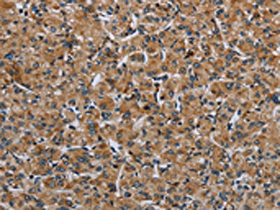 The image on the left is immunohistochemistry of paraffin-embedded Human prostate cancer tissue using the antibody Antibody) at dilution 1/30, on the right is treated with fusion protein. (Original magnification: ×200)