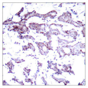 Immunohistochemical analysis of paraffin-embedded human breast carcinoma tissue using Elk1(Ab-389) AntibodyRabbit anti-Human ELK1 Polyclonal Antibody