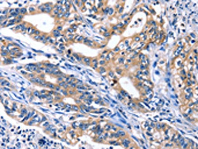 The image on the left is immunohistochemistry of paraffin-embedded Human gastric cancer tissue using CDK2 Antibody(CDK2 Antibody) at dilution 1/30, on the right is treated with fusion protein. (Original magnification: ×200)Rabbit anti-Human CDK2 Polyclonal Antibody