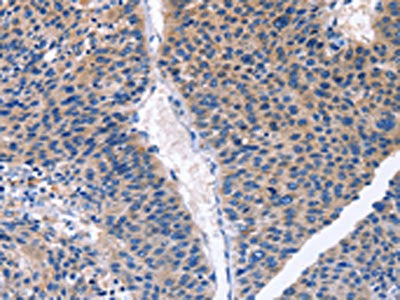 The image on the left is immunohistochemistry of paraffin-embedded Human liver cancer tissue using the antibody Antibody) at dilution 1/30, on the right is treated with fusion protein. (Original magnification: ×200)Rabbit anti-Human CDK2 Polyclonal Antibody