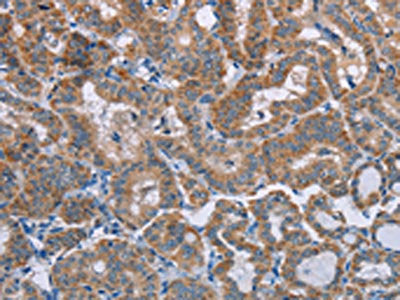 The image on the left is immunohistochemistry of paraffin-embedded Human thyroid cancer tissue using the antibody Antibody) at dilution 1/50, on the right is treated with synthetic peptide. (Original magnification: ×200)Rabbit anti-Human POMT1 Polyclonal Antibody