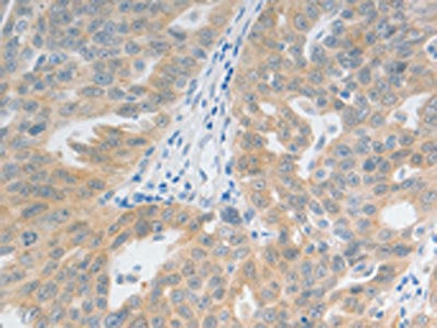 The image on the left is immunohistochemistry of paraffin-embedded Human ovarian cancer tissue using TACR2 Antibody(TACR2 Antibody) at dilution 1/20, on the right is treated with synthetic peptide. (Original magnification: ×200)Rabbit anti-Human TACR2 Polyclonal Antibody