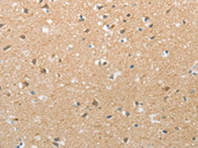 The image on the left is immunohistochemistry of paraffin-embedded Human brain tissue using the antibody Antibody) at dilution 1/20, on the right is treated with synthetic peptide. (Original magnification: ×200)Rabbit anti-Human TACR2 Polyclonal Antibody
