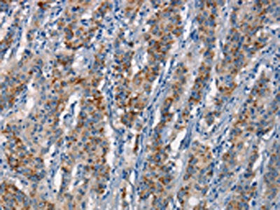The image on the left is immunohistochemistry of paraffin-embedded Human gastric cancer tissue using CDC23 Antibody(CDC23 Antibody) at dilution 1/70, on the right is treated with synthetic peptide. (Original magnification: ×200)Rabbit anti-Human CDC23 Polyclonal Antibody