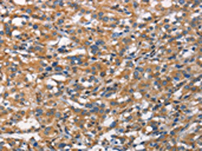 The image on the left is immunohistochemistry of paraffin-embedded Human thyroid cancer tissue using the antibody Antibody) at dilution 1/70, on the right is treated with synthetic peptide. (Original magnification: ×200)Rabbit anti-Human CDC23 Polyclonal Antibody