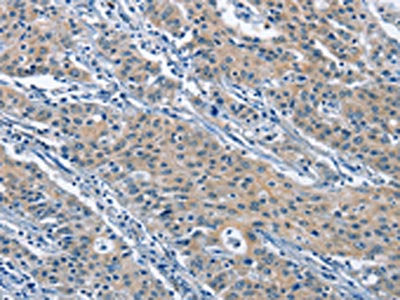 The image on the left is immunohistochemistry of paraffin-embedded Human gastric cancer tissue using KLF7 Antibody(KLF7 Antibody) at dilution 1/60, on the right is treated with fusion protein. (Original magnification: ×200)