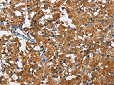 The image on the left is immunohistochemistry of paraffin-embedded Human thyroid cancer tissue using the antibody Antibody) at dilution 1/60, on the right is treated with fusion protein. (Original magnification: ×200)