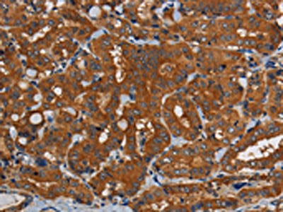 The image on the left is immunohistochemistry of paraffin-embedded Human thyroid cancer tissue using the antibody Antibody) at dilution 1/50, on the right is treated with synthetic peptide. (Original magnification: ×200)Rabbit anti-Human PDE5A Polyclonal Antibody