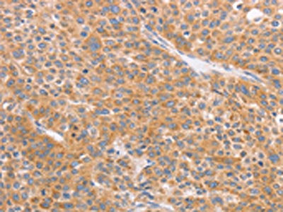 The image on the left is immunohistochemistry of paraffin-embedded Human liver cancer tissue using CD2AP Antibody(CD2AP Antibody) at dilution 1/70, on the right is treated with synthetic peptide. (Original magnification: ×200)Rabbit anti-Human CD2AP Polyclonal Antibody