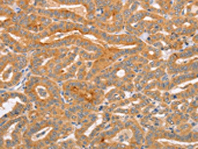 The image on the left is immunohistochemistry of paraffin-embedded Human thyroid cancer tissue using the antibody Antibody) at dilution 1/70, on the right is treated with synthetic peptide. (Original magnification: ×200)Rabbit anti-Human CD2AP Polyclonal Antibody