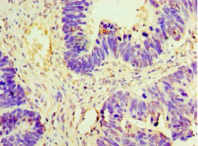 Immunohistochemistry of paraffin-embedded human ovarian cancer using the antibody at dilution of 1:100Rabbit anti-Human AMH Polyclonal Antibody