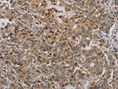 The image on the left is immunohistochemistry of paraffin-embedded Human liver cancer tissue using the antibody Antibody) at dilution 1/35, on the right is treated with synthetic peptide. (Original magnification: ×200)Rabbit anti-Human ERRFI1 Polyclonal Antibody