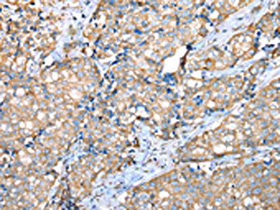 The image on the left is immunohistochemistry of paraffin-embedded Human breast cancer tissue using VAPA Antibody(VAPA Antibody) at dilution 1/30, on the right is treated with fusion protein. (Original magnification: ×200)Rabbit anti-Human VAPA Polyclonal Antibody