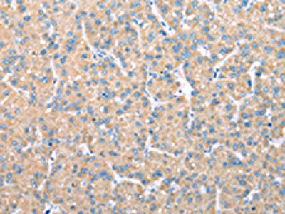The image on the left is immunohistochemistry of paraffin-embedded Human liver cancer tissue using the antibody Antibody) at dilution 1/30, on the right is treated with fusion protein. (Original magnification: ×200)Rabbit anti-Human VAPA Polyclonal Antibody