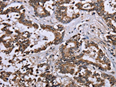 The image on the left is immunohistochemistry of paraffin-embedded Human liver cancer tissue using DUSP4 Antibody(DUSP4 Antibody) at dilution 1/40, on the right is treated with fusion protein. (Original magnification: ×200)Rabbit anti-Human DUSP4 Polyclonal Antibody
