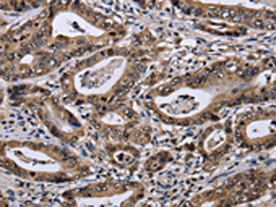 The image on the left is immunohistochemistry of paraffin-embedded Human gastic cancer tissue using the antibody Antibody) at dilution 1/40, on the right is treated with fusion protein. (Original magnification: ×200)Rabbit anti-Human DUSP4 Polyclonal Antibody