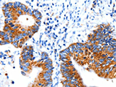 The image on the left is immunohistochemistry of paraffin-embedded Human colon cancer tissue using CLEC7A Antibody(CLEC7A Antibody) at dilution 1/5, on the right is treated with fusion protein. (Original magnification: ×200)Rabbit anti-Human CLEC7A Polyclonal Antibody