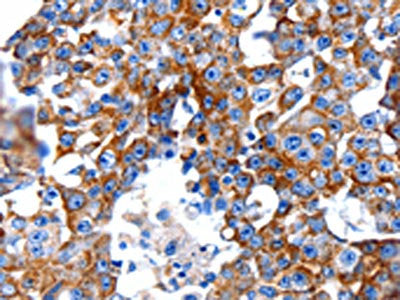 The image on the left is immunohistochemistry of paraffin-embedded Human breast cancer tissue using the antibody Antibody) at dilution 1/5, on the right is treated with fusion protein. (Original magnification: ×200)Rabbit anti-Human CLEC7A Polyclonal Antibody