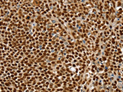 The image on the left is immunohistochemistry of paraffin-embedded Human ovarian cancer tissue using SSB Antibody(SSB Antibody) at dilution 1/30, on the right is treated with synthetic peptide. (Original magnification: ×200)Rabbit anti-Human SSB Polyclonal Antibody