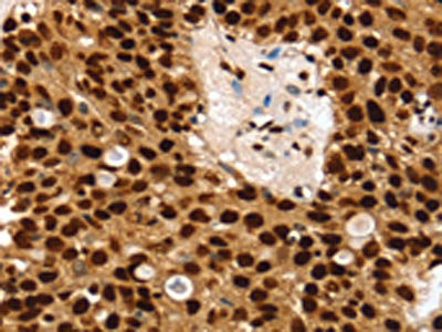 The image on the left is immunohistochemistry of paraffin-embedded Human breast cancer tissue using the antibody Antibody) at dilution 1/30, on the right is treated with synthetic peptide. (Original magnification: ×200)Rabbit anti-Human SSB Polyclonal Antibody