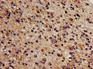 Immunohistochemistry analysis of human glioma using CBS Antibody at dilution of 1:100